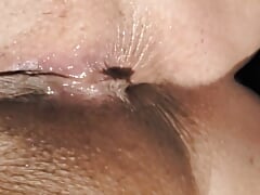 Dilated anus
